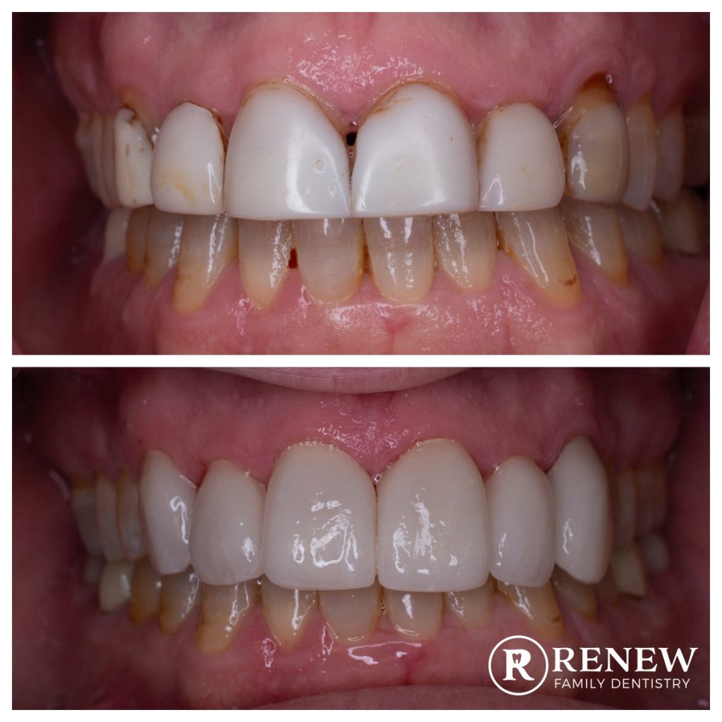 before and after treatment at Renew Family Dentistry in Frisco
