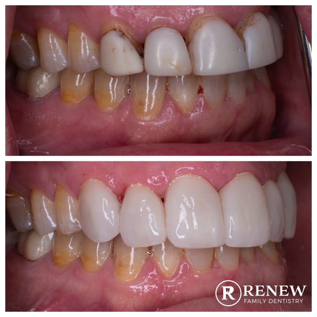 before and after treatment at Renew Family Dentistry in Frisco