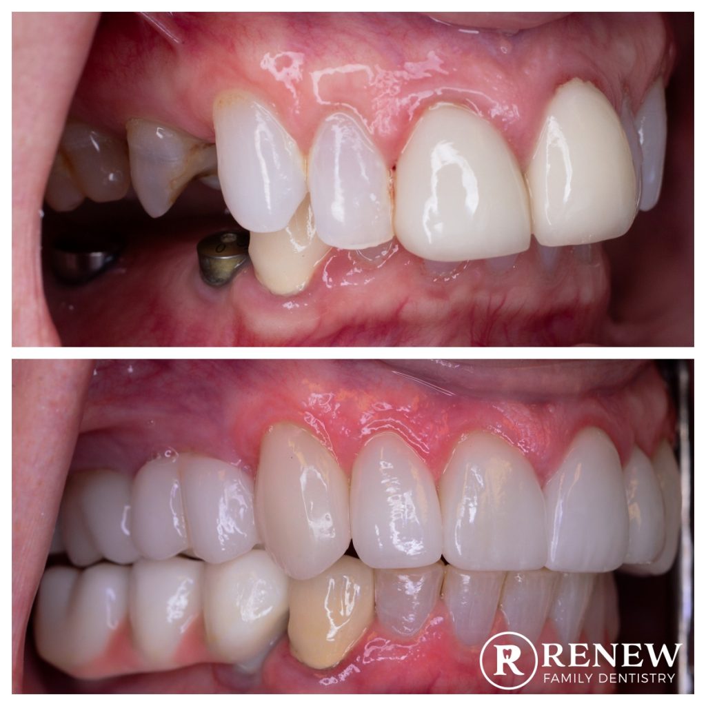 before and after treatment at Renew Family Dentistry in Frisco