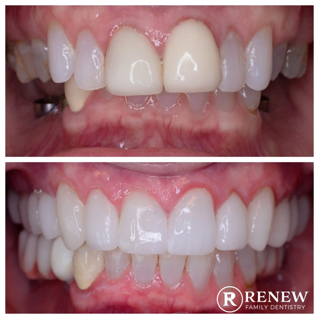 before and after treatment at Renew Family Dentistry in Frisco