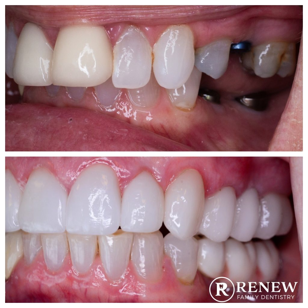 before and after treatment at Renew Family Dentistry in Frisco
