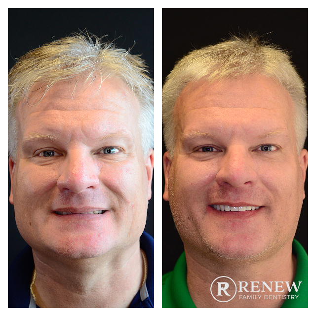 before and after treatment at Renew Family Dentistry in Frisco