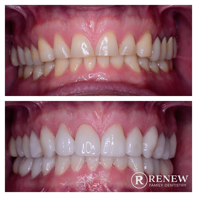 before and after treatment at Renew Family Dentistry in Frisco