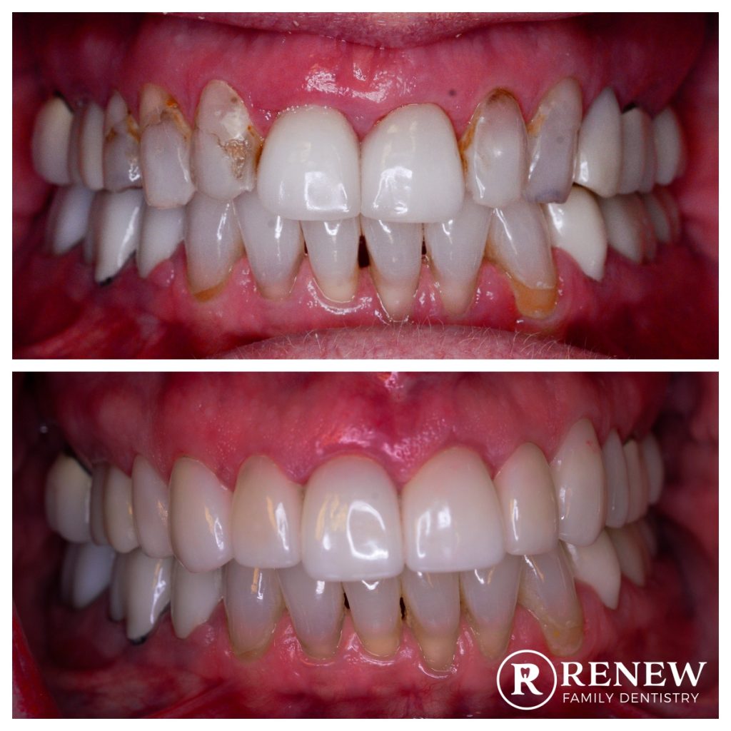 before and after treatment at Renew Family Dentistry in Frisco