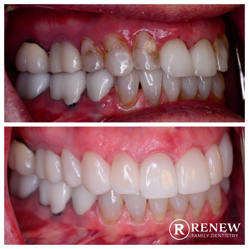 before and after treatment at Renew Family Dentistry in Frisco