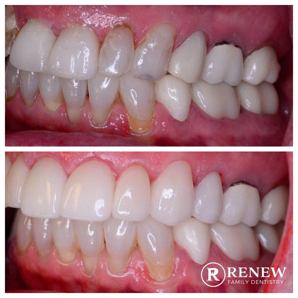 before and after treatment at Renew Family Dentistry in Frisco