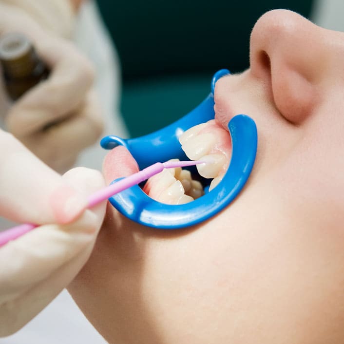 dental bonding in Frisco