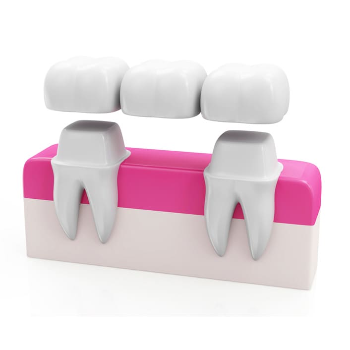 dental bridges in Frisco