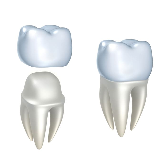 dental crowns in Frisco