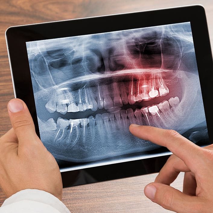 dental x-rays at Renew Family Dentistry in Frisco