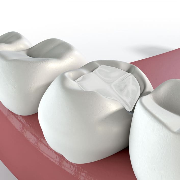 dental fillings in Frisco