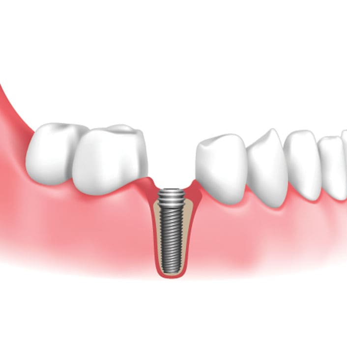 dental implants in Frisco