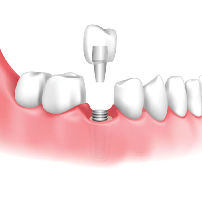 dental implants in Frisco