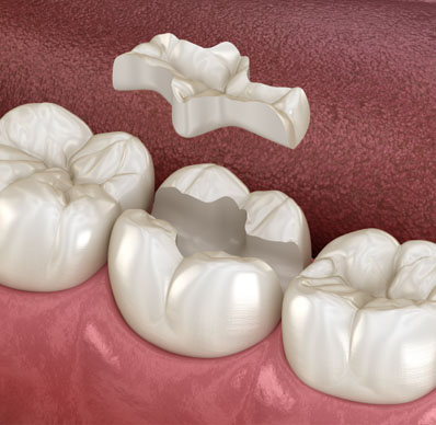 restorative dentistry in Frisco