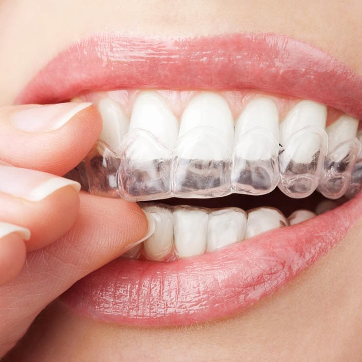 Invisalign in Frisco
