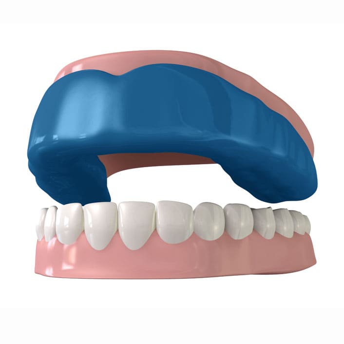 custom mouth guards at Renew Family Dentistry in Frisco