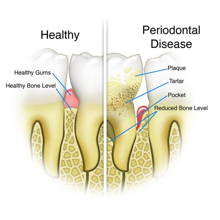 healthy tooth vs tooth with periodontal disease