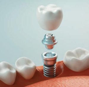 Dental implant components including a titanium post, abutment, and crown, illustrating the dental implant process relevant to missing teeth solutions.
