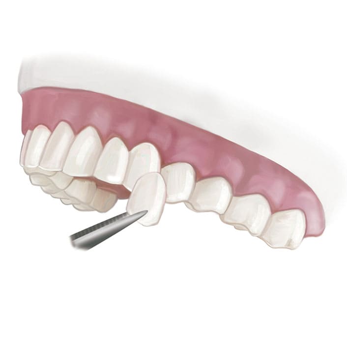 porcelain veneers in Frisco