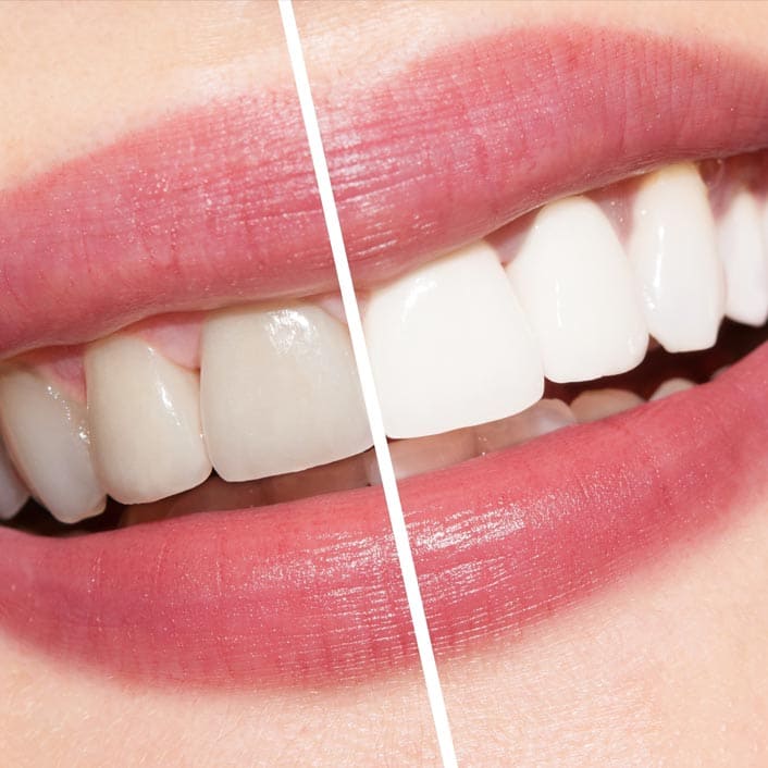before and after teeth whitening in Frisco