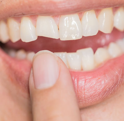 Teeth whitening in Frisco