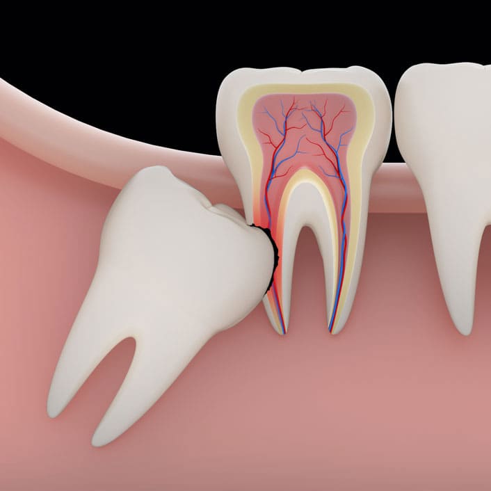 wisdom teeth impactions