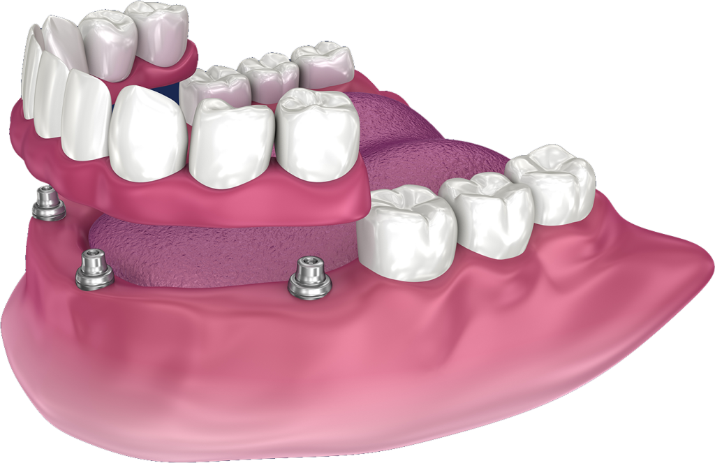overdentures/snap in dentures in frisco, tx