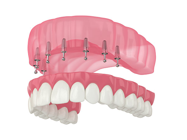 snap-in dentures in frisco