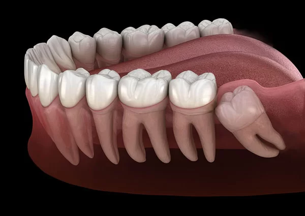 wisdom teeth removal at Renew Family Dentistry